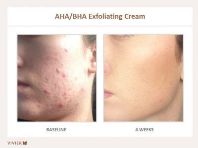 AHA-BHA Before and After - MD Skin Cosmetic Clinic