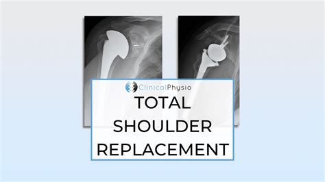 Total Shoulder Replacement: Standard vs. Reverse – Clinical Physio ...