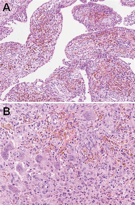 Giant Cell Tumor Histology