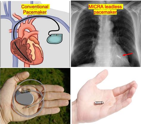 World’s smallest and lightest leadless pacemaker MICRA implanted at ...