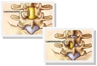 Foraminotomy Vs Laminectomy