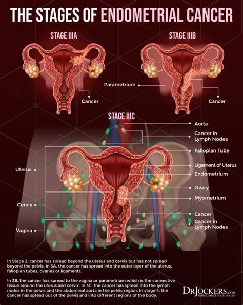 Endometrial Cancer: Symptoms, Causes, and Support Strategies