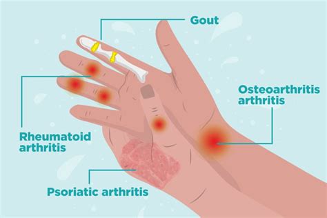 Arthritis in Hands: Symptoms, Types of Hand Arthritis, and Treatment