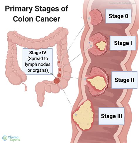 FOLFIRI + Avastin treats Colon Cancer | ChemoExperts