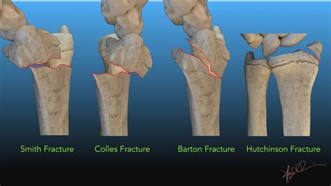 Common Distal Radial Fractures | UW Emergency Radiology