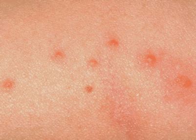 Dust Mite Bites Pictures, Symptoms on Human, Allergy, Rash, How to Get ...