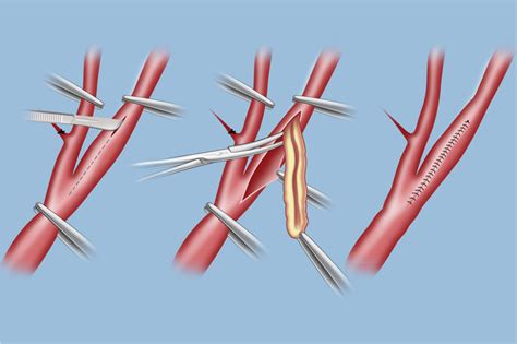 Surgery for Carotid Occlusive Disease | Weill Cornell Brain and Spine ...