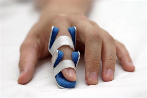 Sprained finger: Symptoms, treatment, and recovery