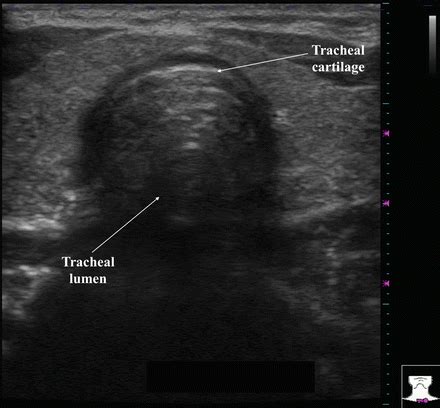 Normal Thyroid Appearance and Anatomic Landmarks in Neck Ultrasound ...