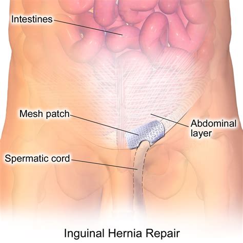 Tips for Recovery From an Inguinal Hernia Surgery - Patient's Lounge