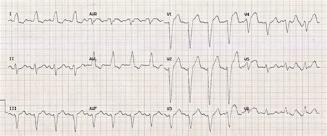 Percent of ivcd vs rbbb crt - doctorsnet