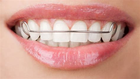 Types of Braces – Orthodontics in the Highlands