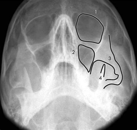 Cpt code for closed reduction of zygomatic arch fracture - sherysd