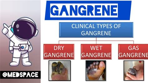 GANGRENE & ITS TYPES | CELL INJURY| GENERAL PATHOLOGY - YouTube