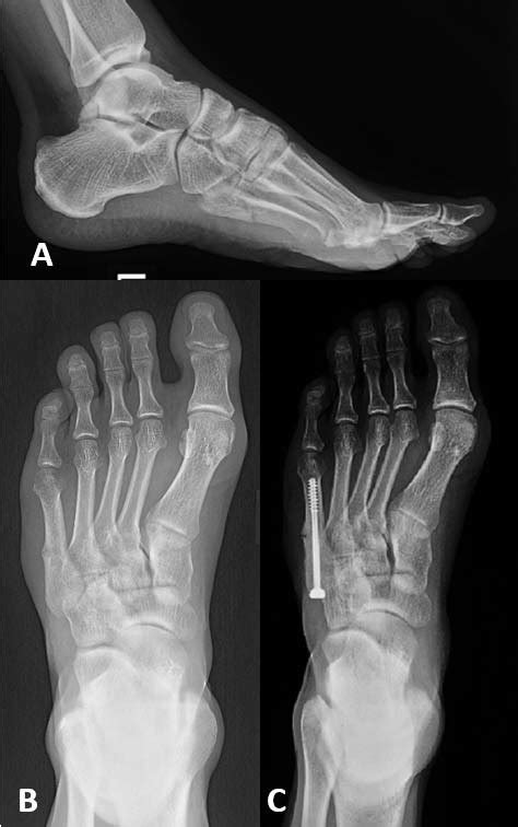 X-ray of the fifth metatarsal fracture in left foot in an elite soccer ...