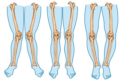 Valgus And Varus Knee Patterns And Knee Pain | 3D Muscle Lab