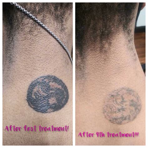 Enlighten Laser Tattoo Removal | Medical Aesthetics of Suwanee