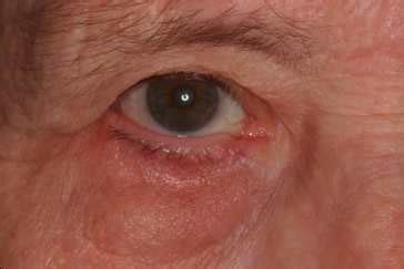 Photos of Entropion Surgery - Senile/Involutional | Eyelid Plastic Surgery