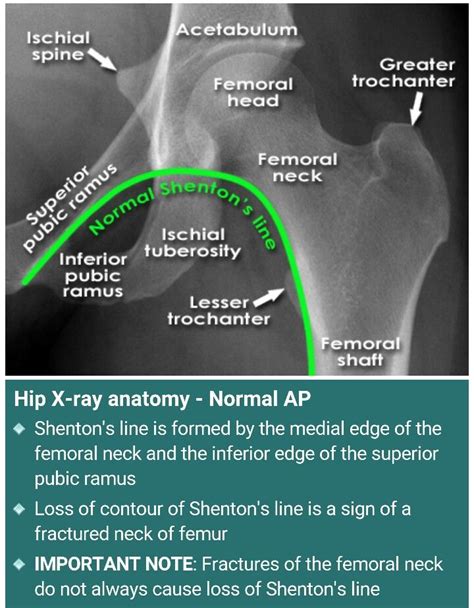 Hip x ray..loss of Shenton's line is a sign of fx neck of femur. La ...