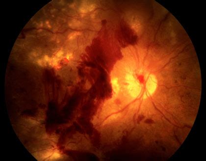 Diabetic Retinopathy — Retina Macula Institute