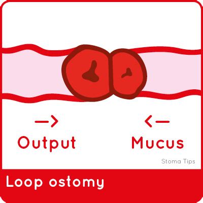 StomaTips - Stoma reversal: what to expect after