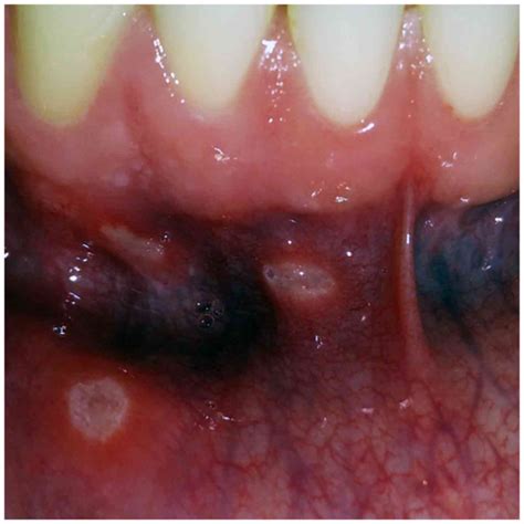 Aphthous Stomatitis Treatment