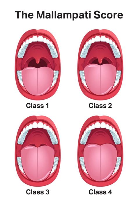 Mallampati Score and Predicting Sleep Apnea | Sleep Foundation