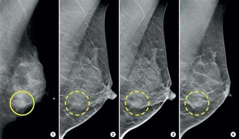 3-D mammograms may improve accuracy of breast cancer screening