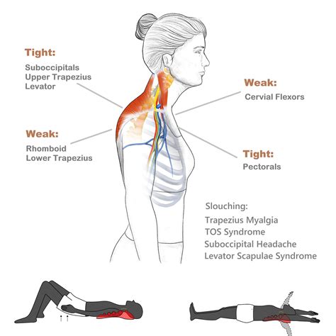 Trapezius Muscle Pain | ubicaciondepersonas.cdmx.gob.mx