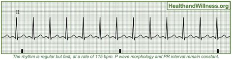 A Nurse Is Reviewing the Ecg Rhythm Strip - Elston Leye1985