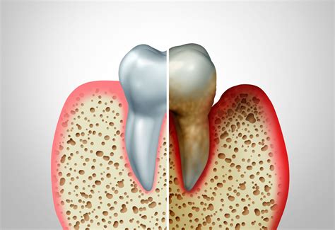 Periodontist Waldorf | What Research Tells Us About Periodontal Disease