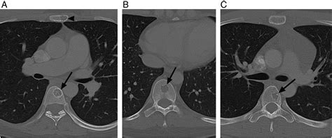 CT features of generalized lymphangiomatosis in adult patients ...