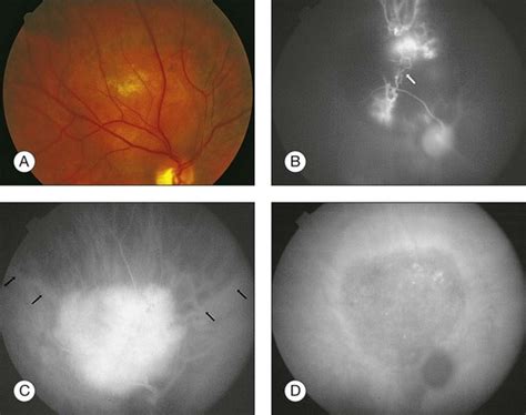 Circumscribed Choroidal Hemangioma | Ento Key