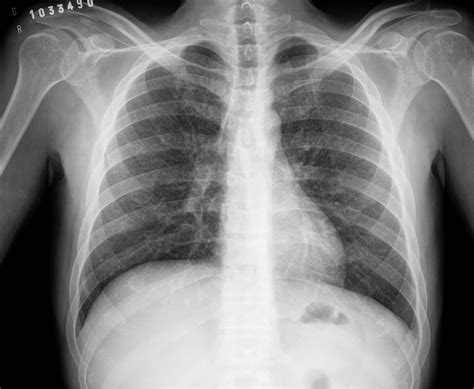 Tuberculosis, Miliary