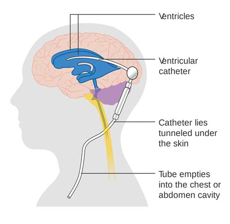 Ventriculoperitoneal Shunt - Treatment for Intracranial Pressure