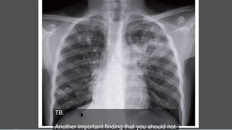 Abnormal Chest X Ray Tuberculosis