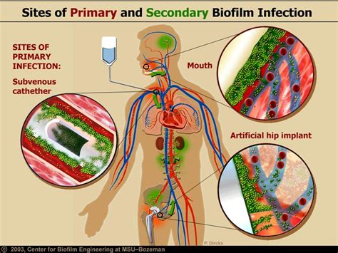 Biofilm bacteria (MPKB)