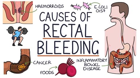 Understanding the Causes of Blood in Stool (Rectal Bleeding) - YouTube