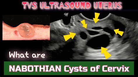 Nabothian Cysts Of Cervix Tvs Ultrasound Is This Serious Youtube | Free ...