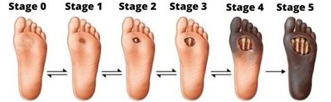 Wagner Classification Of Diabetic Foot Ulcer