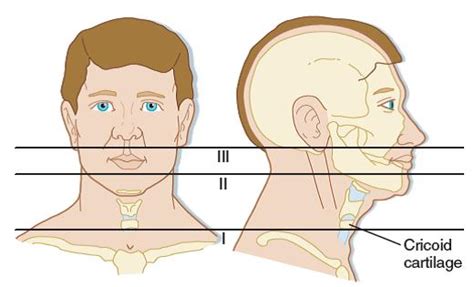 emDOCs.net – Emergency Medicine EducationNeck Trauma: A Practice Update ...