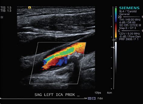 Pathophysiology Stenosis Carotid Artery Vascular Ultrasound | The Best ...