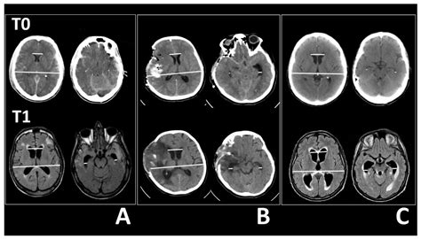 Tomography | Free Full-Text | Temporal Horn Enlargements Predict ...