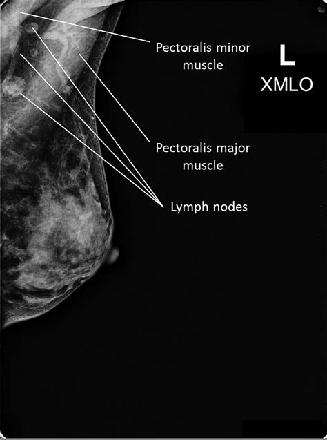 Mammogram - Screening, Diagnostic, 3d - Guidelines & Age