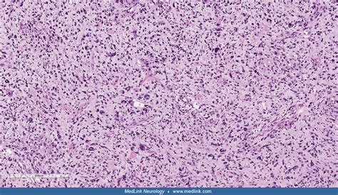 Pleomorphic xanthoastrocytoma | MedLink Neurology