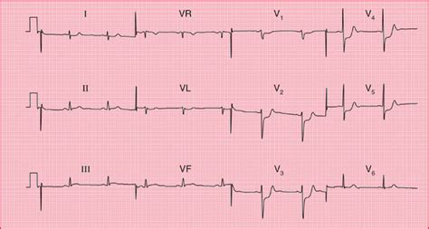 The ECG in Patients With Chest Pain or Breathlessness | Thoracic Key