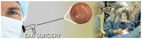 Stapedectomy | Ear Institute of Chicago