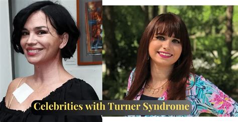 12 Famous People And Celebrities With Turner Syndrome