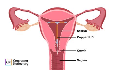 Copper Iud Removal Side Effects / Hormonal Iuds Wikipedia : It can be ...