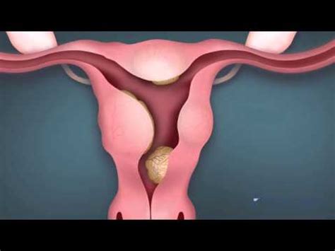 Sonohysterogram Procedure - YouTube